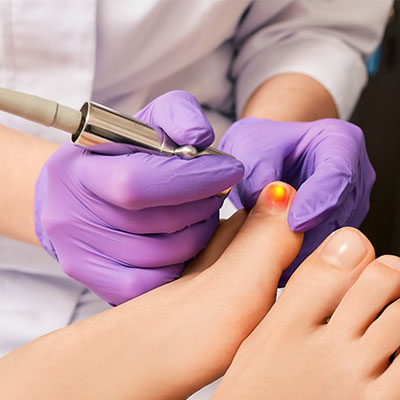 laser treatment for toenail fungus