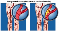 Common Signs of Peripheral Artery Disease in the Feet