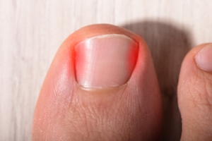 Surgery for Ingrown Toenails