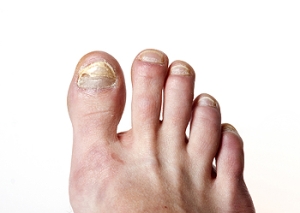 Preventive Measures for Toenail Fungus
